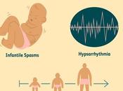 Ayurvedic Treatment Typical Hypsarrhythmia