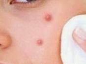 What Acne? Ayurvedic Treatment Removal