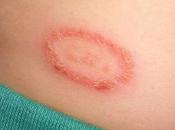 What Ringworm? Treat Ringworm Natural Medicines