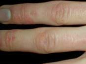 What Scleroderma? Causes, Symptoms Treatment