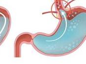 Best Natural Treatment Acidity Acid Reflux