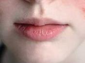 What Lupus? Ayurvedic Treatment Cure Naturally