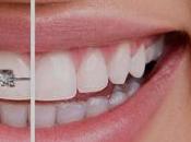 Need Orthodontist Straighten Your Teeth?