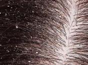 Scalp Infection Severe Dandruff Naturally?