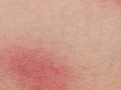 What with Skin Irritations?