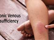 Ayurvedic Treatment Chronic Venous Insufficiency