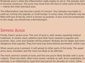 Acne: Characteristics, Causes Treatment