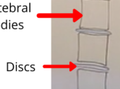 Lesson Whiteboard: Herniated Disc, Bulging Disc Protrusion