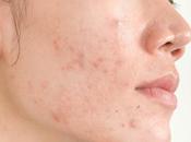 Ayurvedic Herbs Help Relieving Skin Disorders