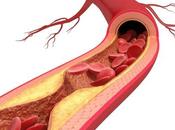 Home Remedies Prevent Athrosclerosis