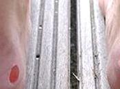 Home Remedies Foot Blisters