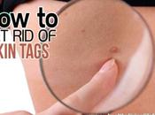 Remove Skin Tags, Causes, More Healthylivinglifefacts