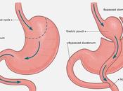 Bariatric Surgery Metabolic Health Weight Loss