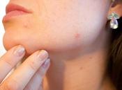 Painful Pimples Ways