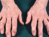 Rhemataoid Arthritis (Aama Vata)