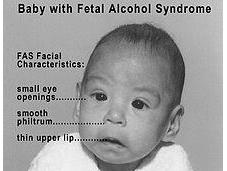 Misdiagnosing Fetal Alcohol Spectrum Disorder