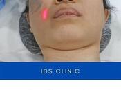 Reduce Pigmentation with Switch Laser Treatment Clinic