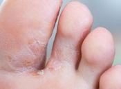 Home Remedies Fungal Infections