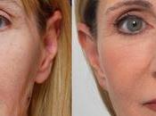 What Facelift? Should