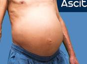 Ascites Prevention Care Ayurvedic Treatment