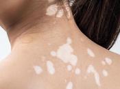 Leucoderma/vitiligo