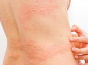 Skin Rashes
