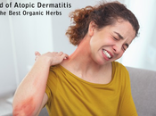 Atopic Dermatitis with Herbal Remedies