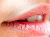 Home Remedies Chapped Lips
