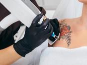 Visit Best Laser Tattoo Removal Service Quick