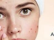 Herbal Remedies Acne Vulgaris Causes Symptoms