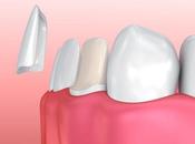 Dental Implants Veneers Same Thing?