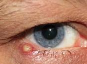 Herbal Remedies Stye