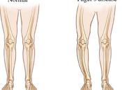 Herbal Remedies Paget’s Disease