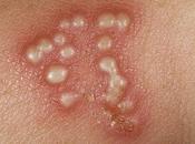 Herbal Remedies Herpes Zoster (Shingles)