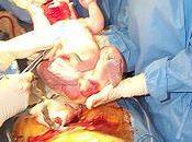 Frightened Having Another C-Section After Traumatic Birth