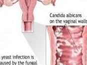 Yeast Infection Signs, Symptoms Treatment