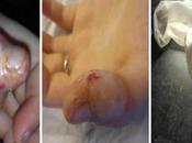 Paronychia Finger Pulp Infection Causes Kate Pain