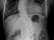 Fight with Idiopathic Scoliosis