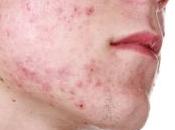Does Acne Start Gut?