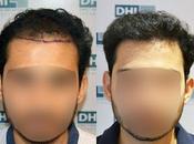 Want Makeover with Hair Transplant Chandigarh?