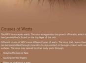 Warts: Causes, Characteristics Treatment