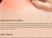 Pruritus (Itchy Skin): Symptoms, Causes Treatment