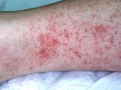 Ayurvedic Treatment Rocky Mountain Spotted Fever (rmsf)