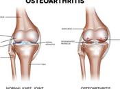 Natural Cure Osteoarthritis