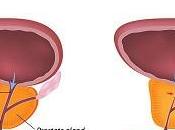 Best Ancient Herbs Remedies Restoring Healthy Prostate