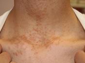 Eruptive Syringoma Treatment with Herbal Remedies