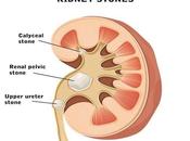 Ayurvedic Aspect Renal Calculi