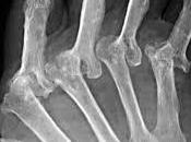 Ayurveda Rheumatoid Arthritis
