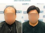 Hair Transplant Permanent Solution Loss