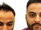 What Makes Popular Place Hair Transplant Jaipur?